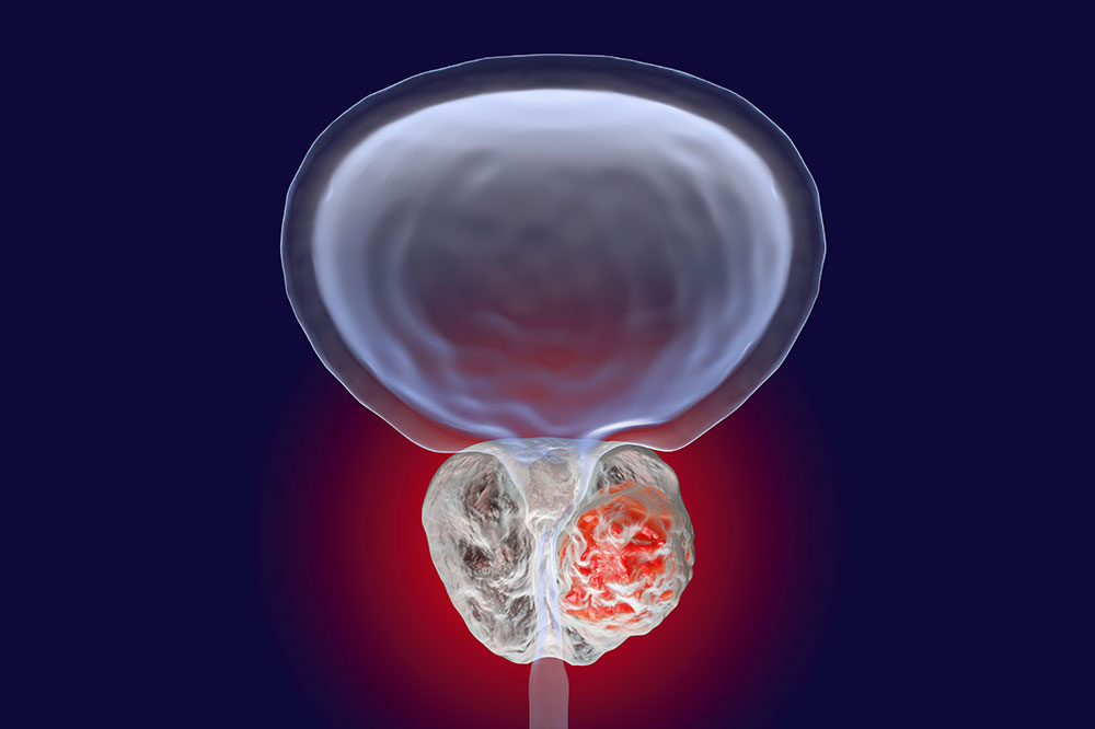 The Relationship Between Genetics and Prostate Cancer