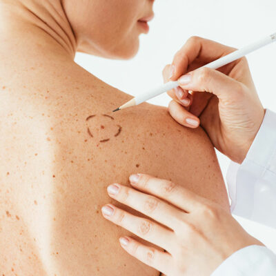 Tips to Reduce the Risk of Melanoma