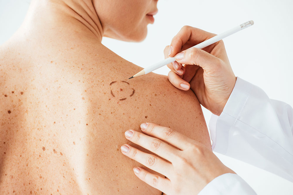 Tips to Reduce the Risk of Melanoma