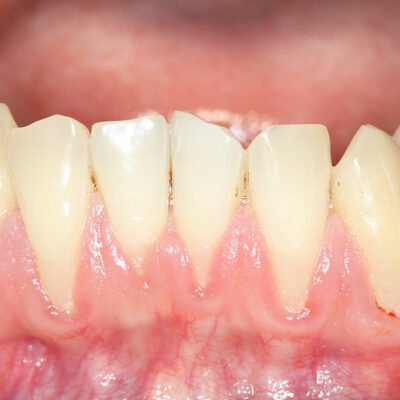 6 Early Warning Signs of Osteoporosis