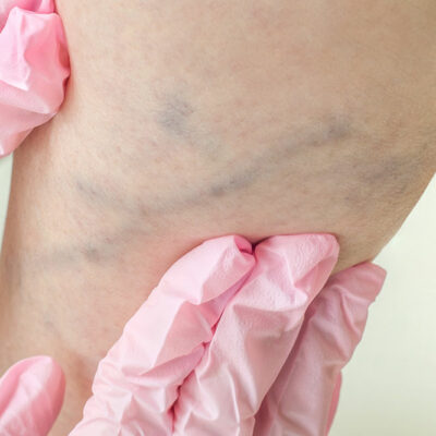 6 Major Symptoms of Deep Vein Thrombosis