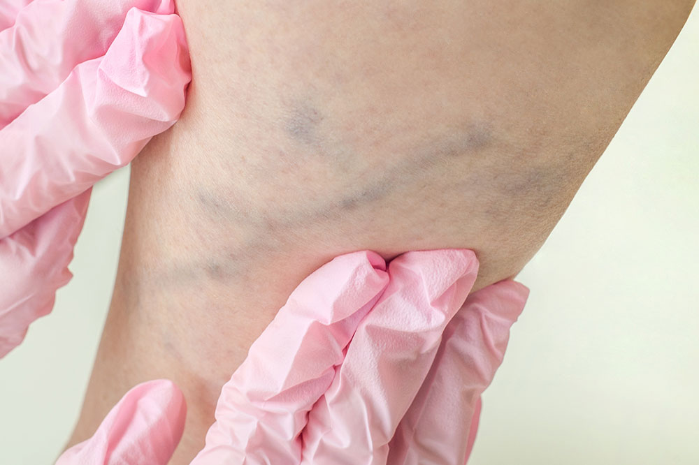 6 Major Symptoms of Deep Vein Thrombosis